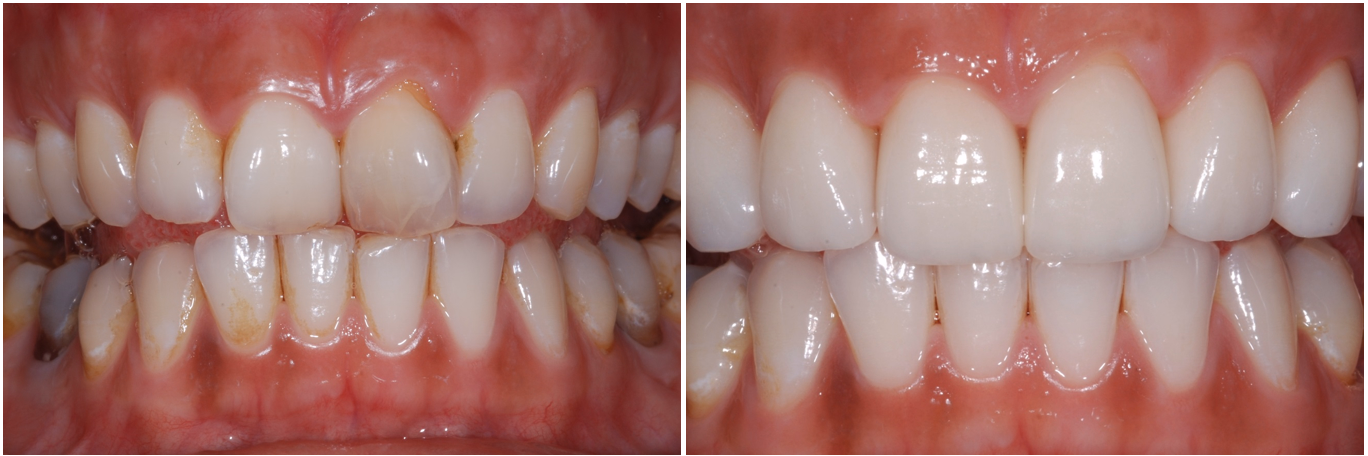 Schoene Zähne dank Veneers beim Zahnarzt am Spelterini in St. Gallen