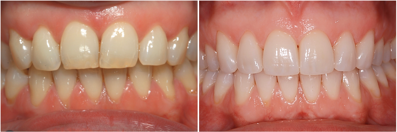 schoene Zähne dank Veneers beim Zahnarzt am Spelterini in St. Gallen