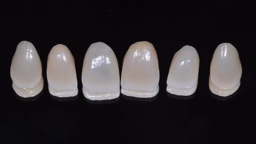 schoene Zähne dank Veneers beim Zahnarzt am Spelterini in St. Gallen